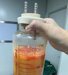 铁岭水动力吸脂手术要做多久？